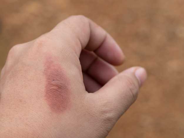 Аллергия: царапины на коже и способы их устранения