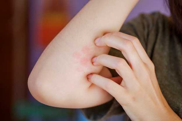 Симптомы аллергии на коже у взрослого