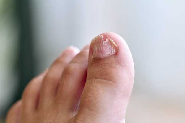 Симптомы грибка ногтей на руках после гель лака