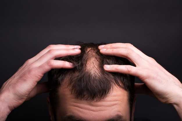 Медикаментозное лечение: эффективные препараты для роста волос