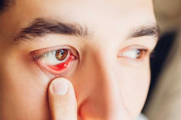 Капли для кровоизлияния в глаз: эффективные средства для лечения