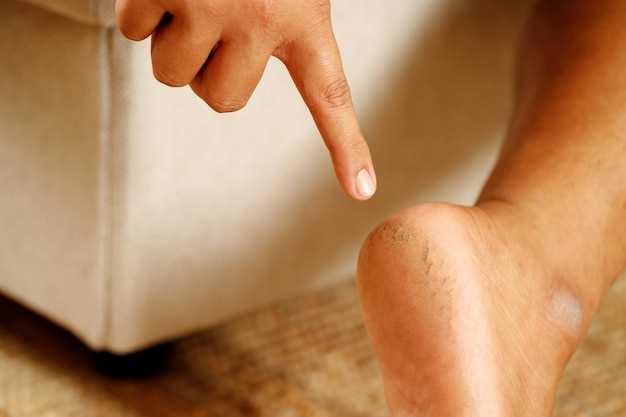 Вросший ноготь болит: причины, симптомы и способы лечения